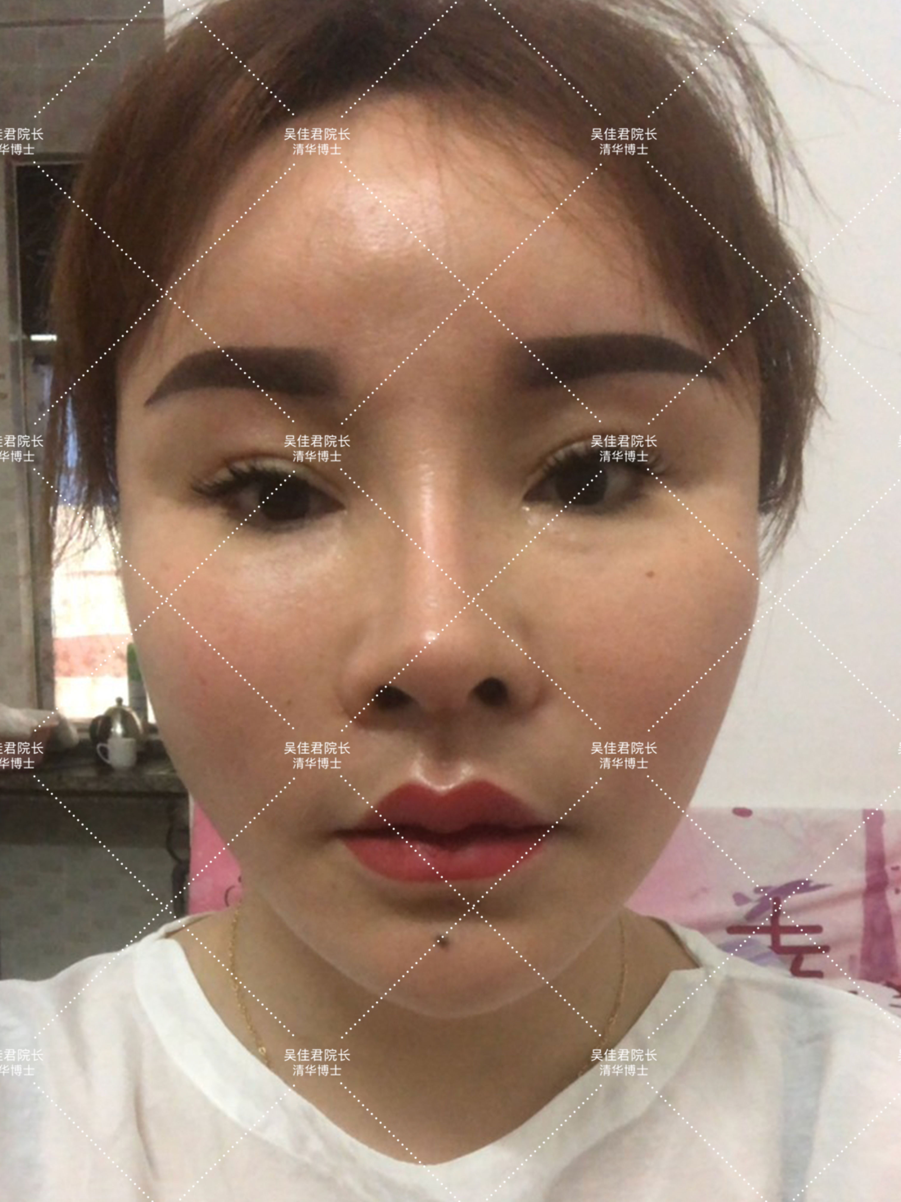 做小拉皮术后怎么保养,做拉皮手术的亲身经历注意事项