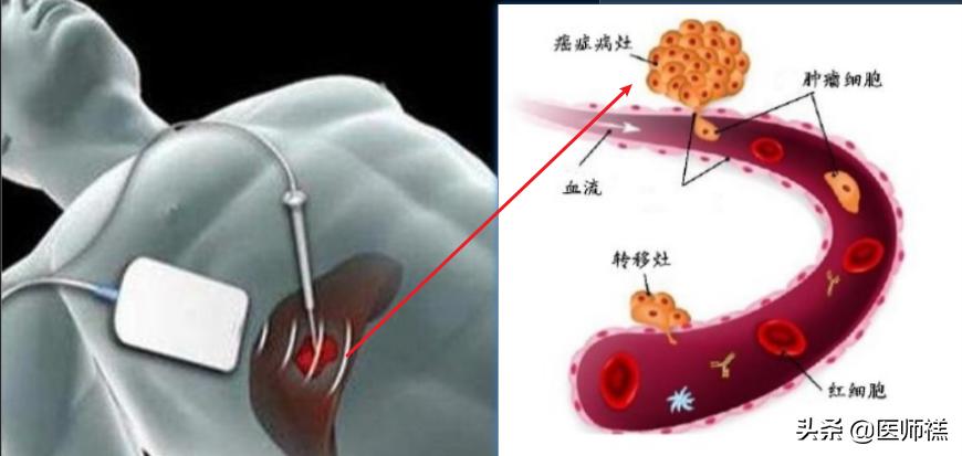 肝囊肿穿刺和微创切除哪个风险大,肝脏穿刺风险和后遗症