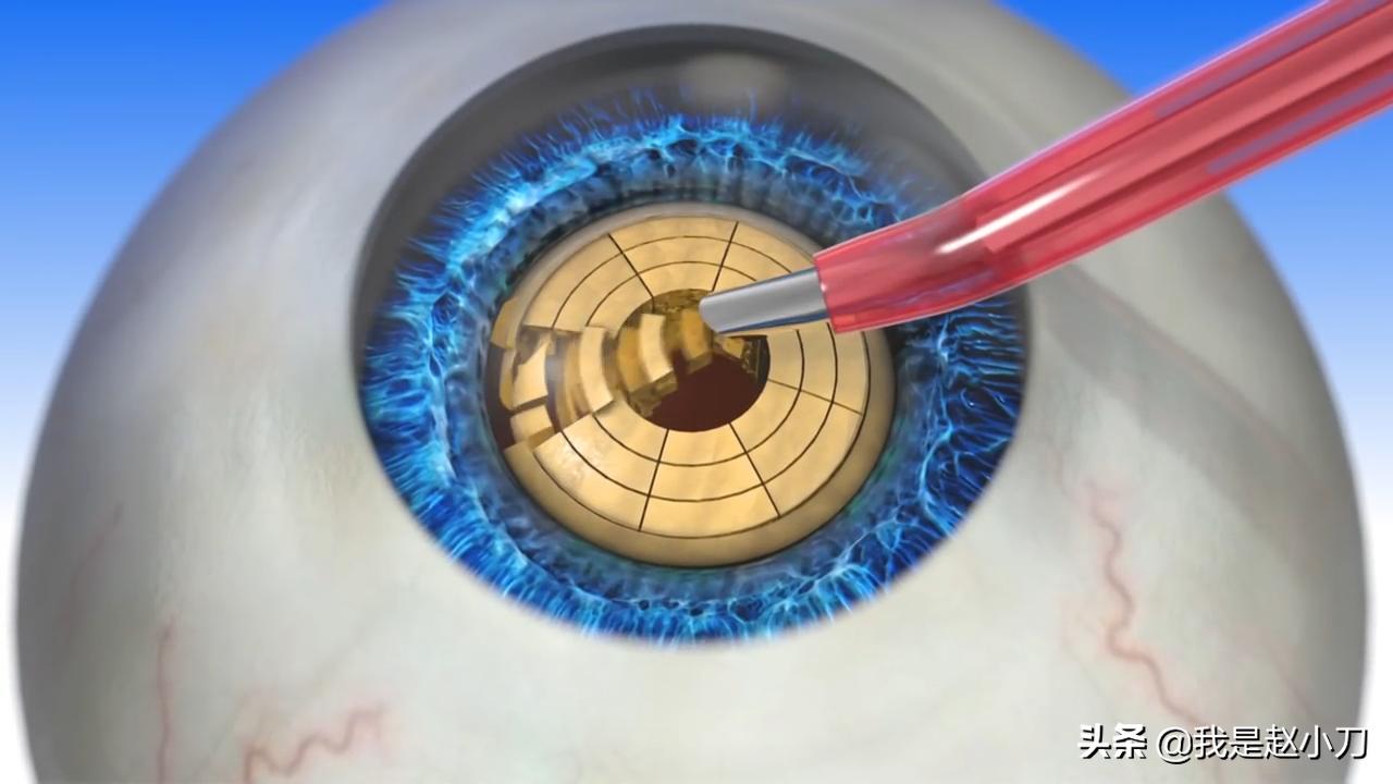 什么手术对白内障最好,老人家最先进的白内障手术过程