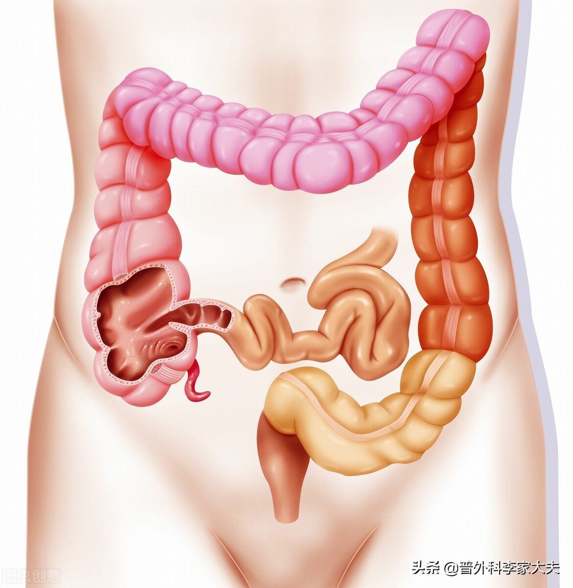 乙状结肠癌术后复发的症状是哪些,术后乙状结肠癌的护理病情汇报