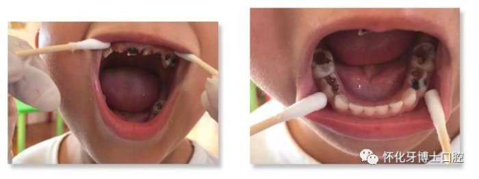 乳牙坏了不用管有恒牙代替对吗,乳牙坏啦不补牙会影响恒牙吗