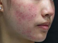 青春痘绝不仅仅影响颜值那么简单,青春痘可能只长一个吗