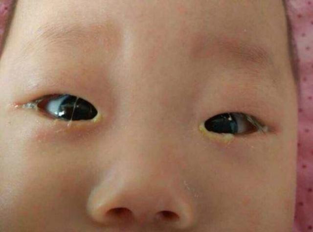 刚满月宝宝眼睛有一只不一样大,刚满月的宝宝眼睛一直红