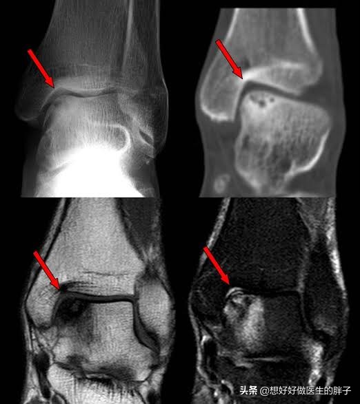 腓骨远端损伤后，如恢复特别慢，有哪些常见原因，又该如何应对呢