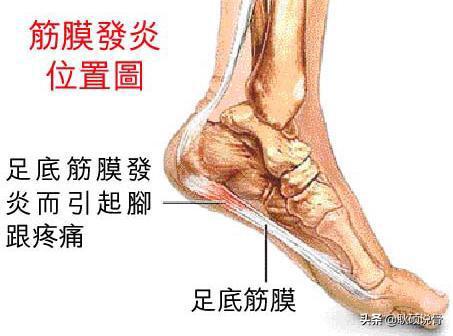 足底筋膜炎居家保健,足底筋膜炎平时走路的技巧
