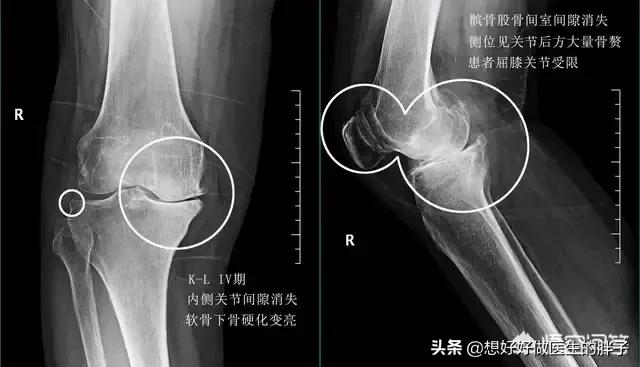 骨刺与骨性关节炎疼痛有什么区别,关节炎骨刺是怎么造成的
