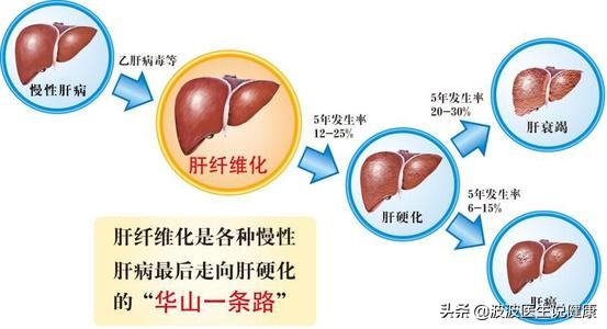 肝硬化肝癌诊治病例分享,2023年肝病防治指南