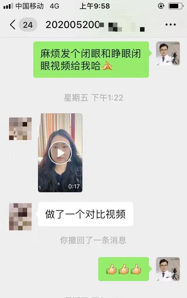 双眼皮修复改扇形双眼皮,平行双眼皮能改成开扇形双眼皮吗