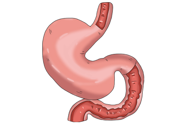 做胃镜怎样反应是胃癌,胃镜就能诊断胃早期癌吗