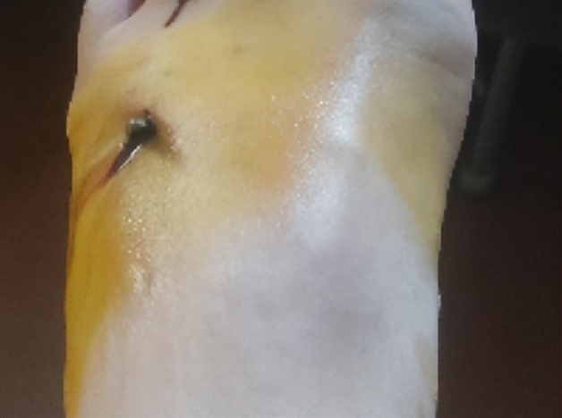 小孩被咬破皮为什么打破伤风针,儿童被大人咬伤要打破伤风针吗