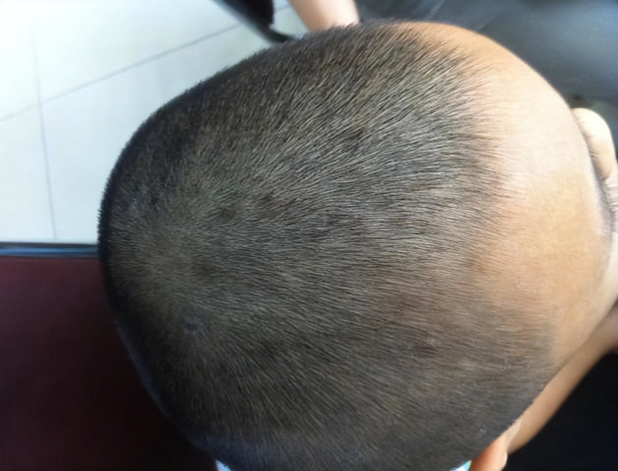 头皮上经常长脓包,头皮经常起疙瘩有脓包是什么原因