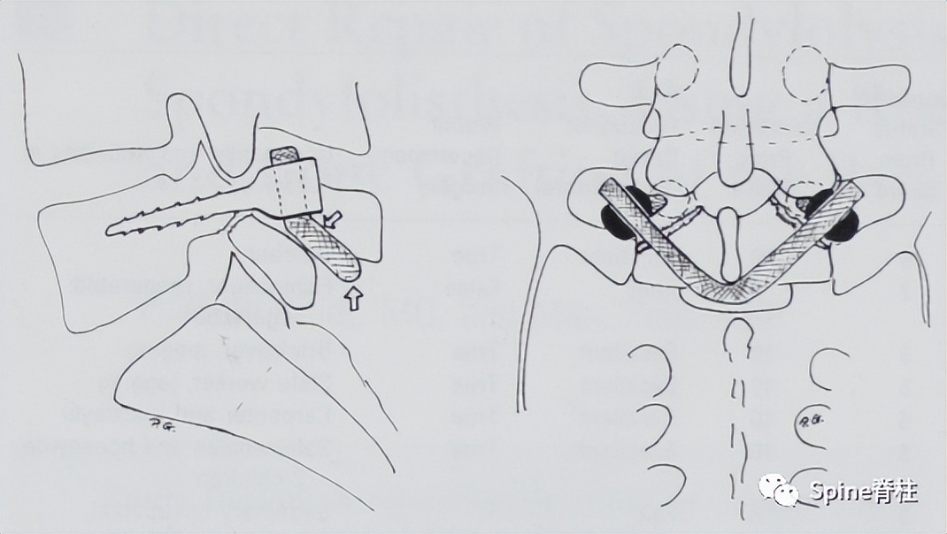 峡部裂和隐性峡部裂有区别吗,单纯峡部裂可以做峡部修复吗