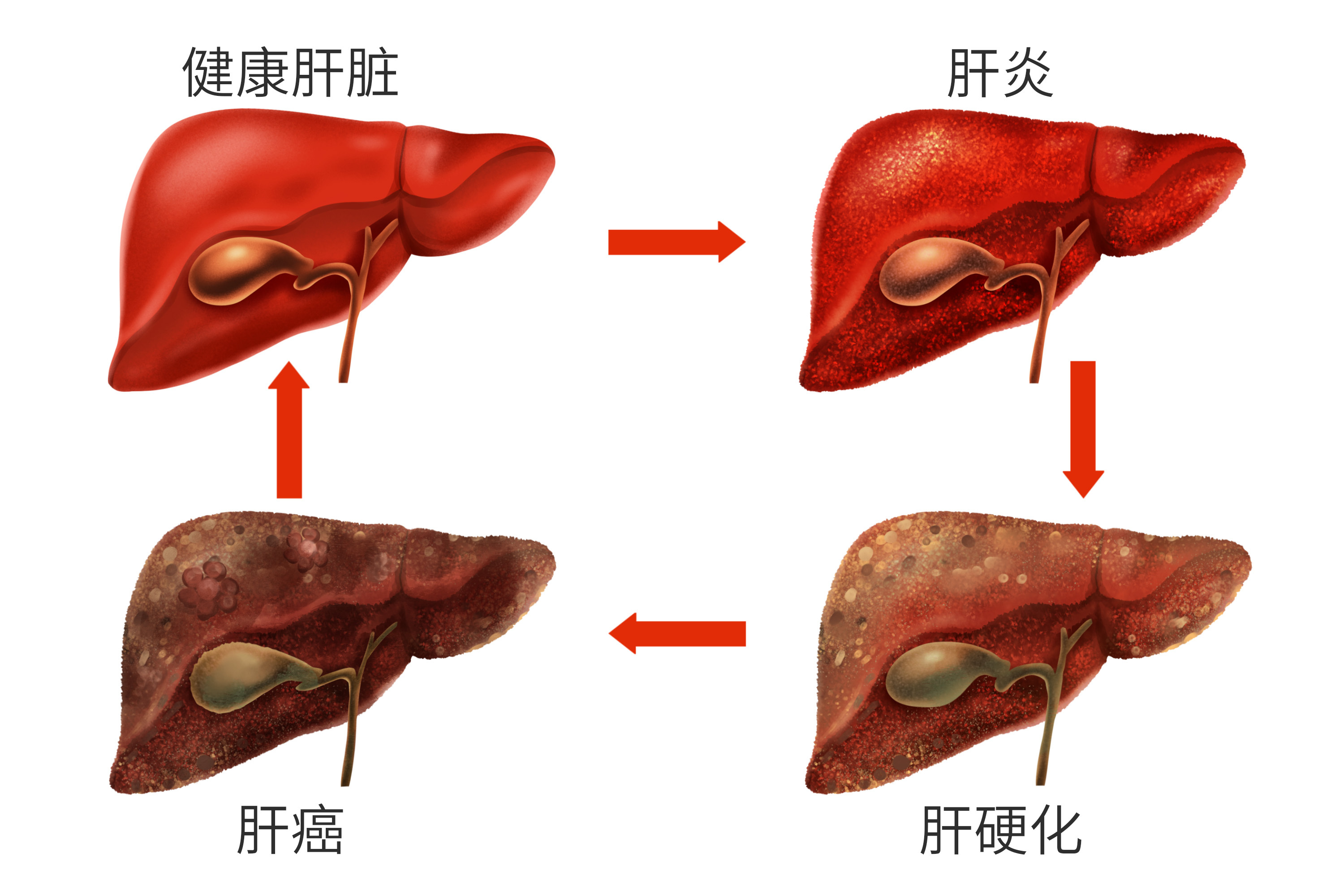 简述对肝硬化患者腹水的护理措施,肝硬化腹水的4个治疗要点