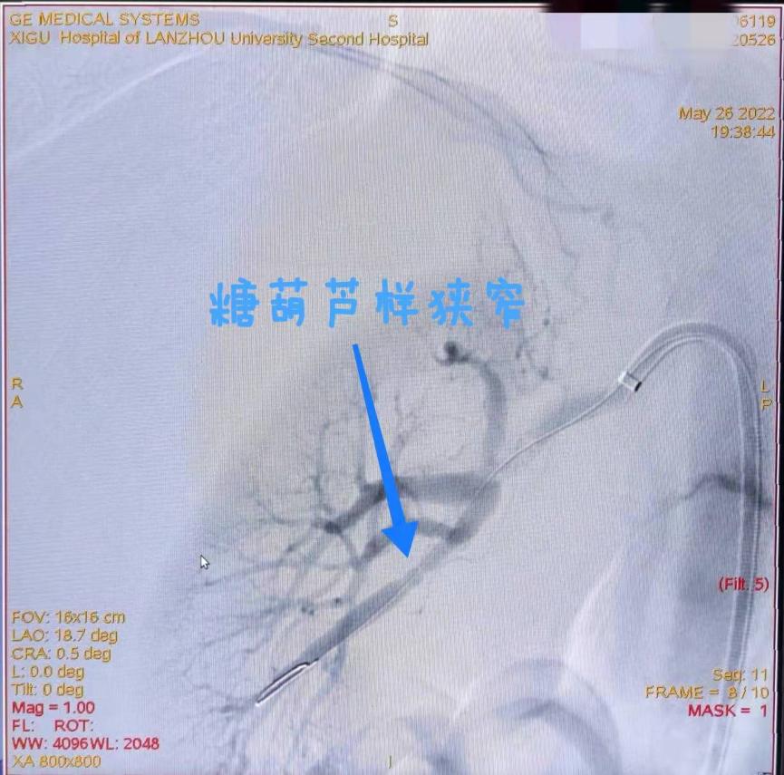 关注青年高血压关注肾动脉狭窄——兰大二院西固医院神经外科成功完成经皮肾动脉狭窄球囊扩张成形术