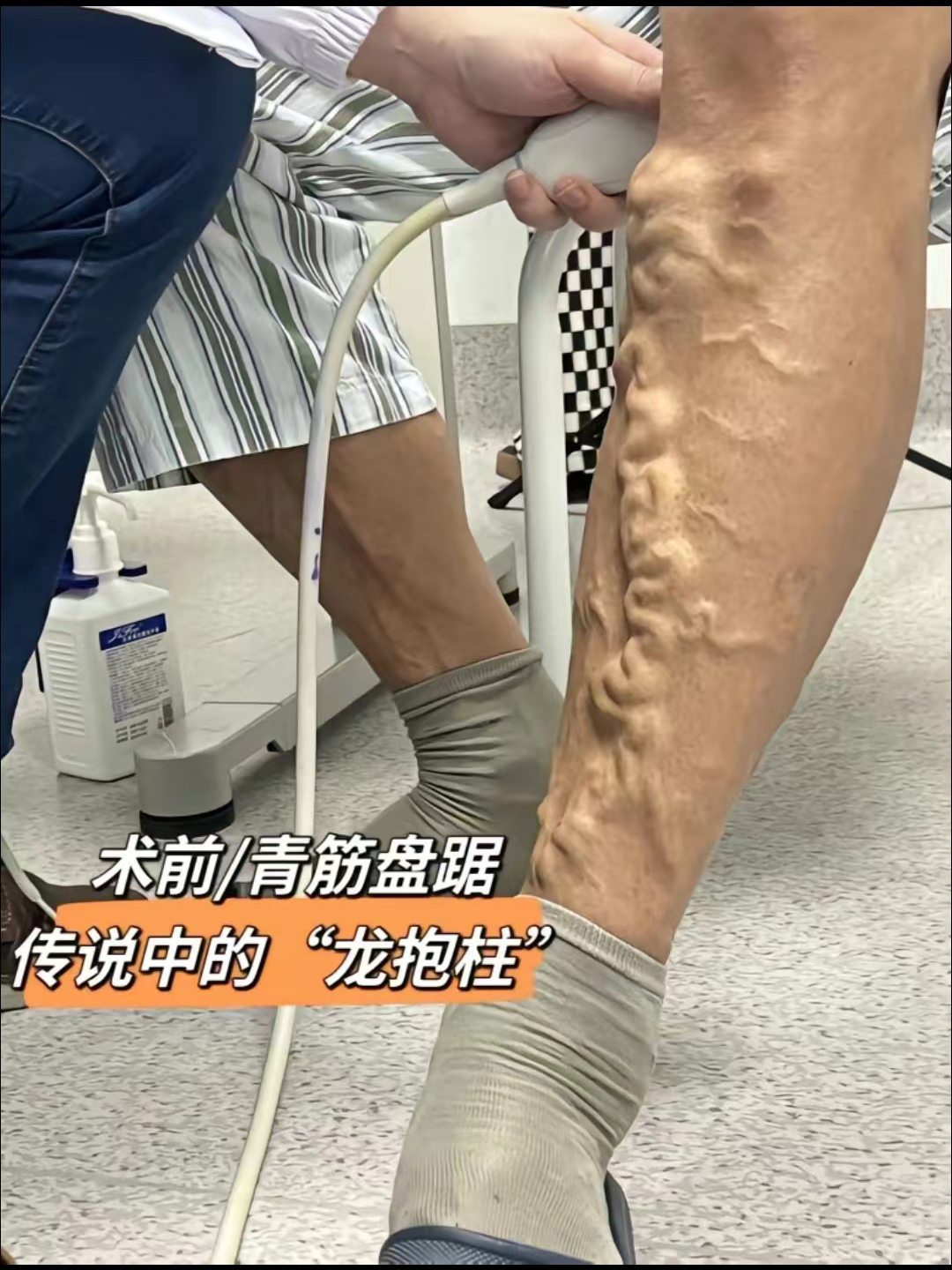 下肢静脉曲张要怎么治疗效果明显,求治疗静脉曲张的好方法