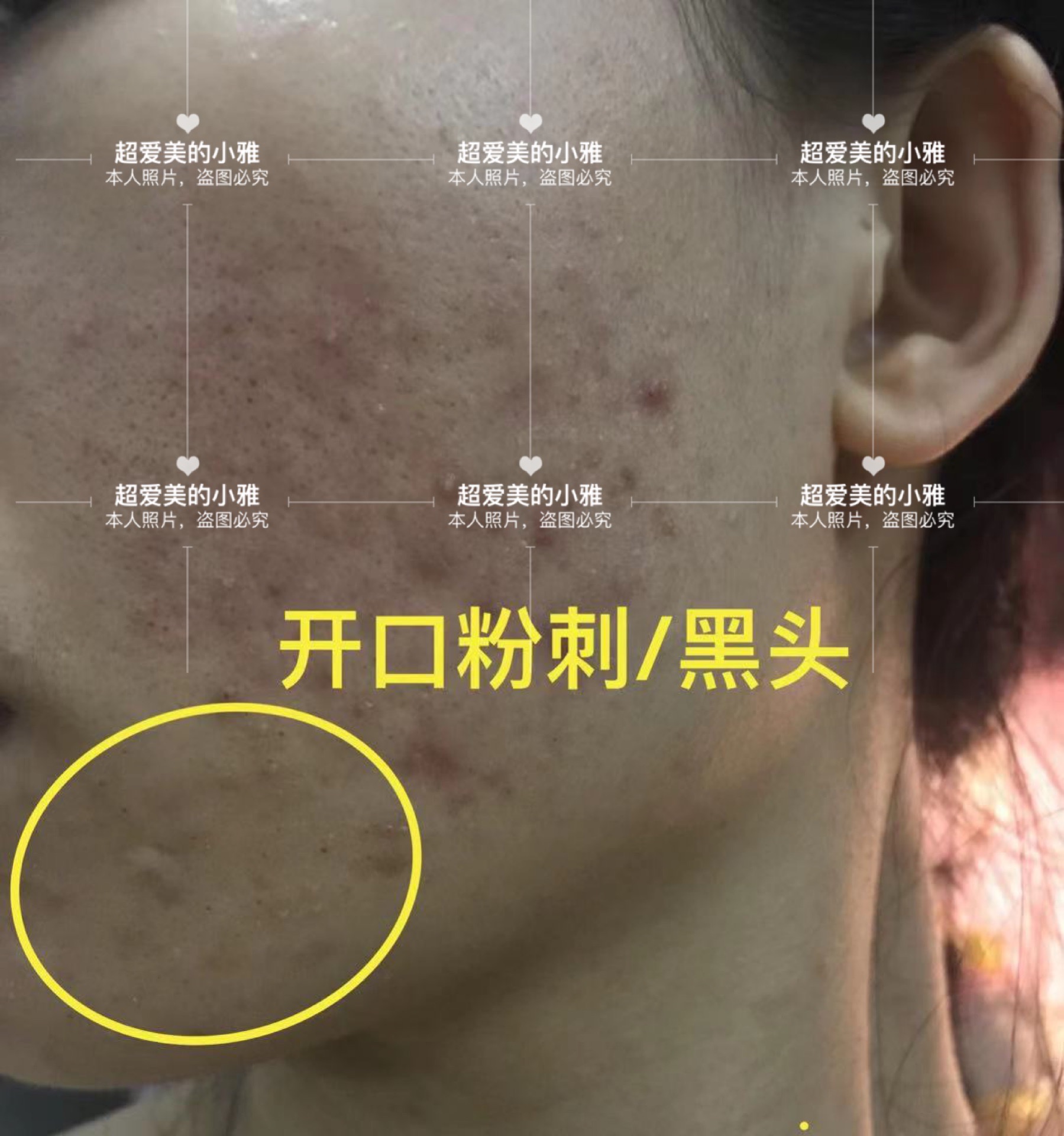 痘痘严重爆发如何战痘到底,痘痘的常见问题解决方法在这里