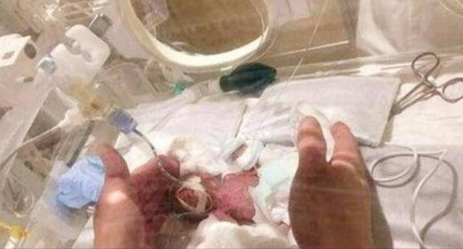 拇指姑娘出生时只有10公分,拇指姑娘出生时仅280克长大