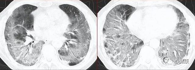 新冠白肺是什么意思,新冠肺炎为什么肺会白