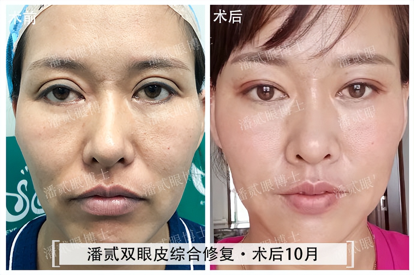 凸眼球显得眼睛大,凸眼眼窝凹陷