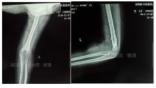 肱骨骨折取钢板怎样恢复,肱骨近端骨折切开复位内固定术