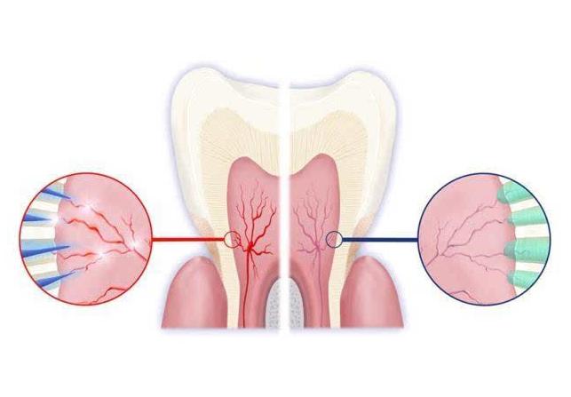 牙齿敏感用什么方法能解决,牙齿敏感快速解决方法