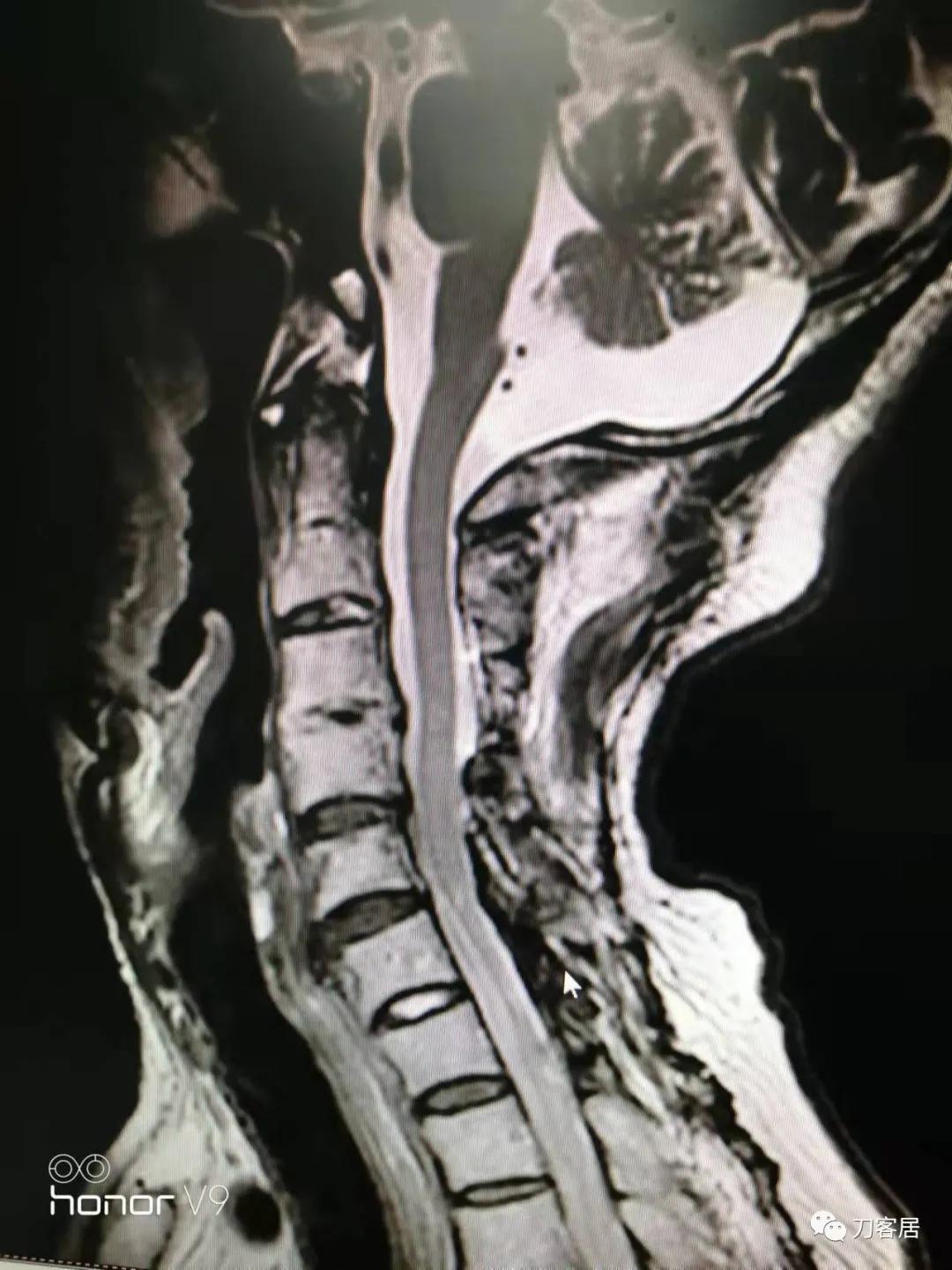 颈椎椎管内肿瘤手术20例麻醉处理,颈椎脊髓内肿瘤手术成功案例