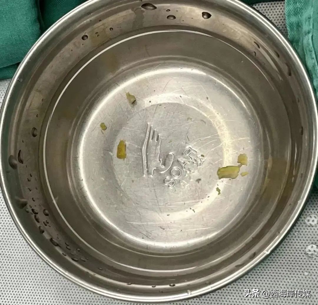 开心果卡进孩子肺里后续,小孩子吃开心果呛到气管视频