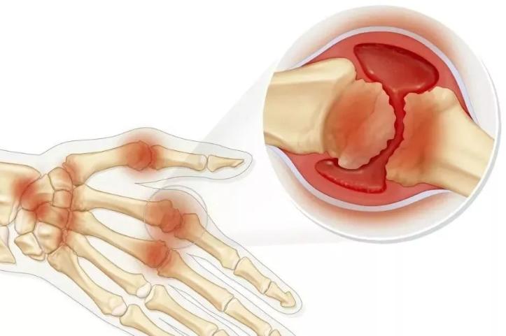 58岁女性骨性关节炎怎样治疗,肥胖导致的骨关节炎可以治好吗