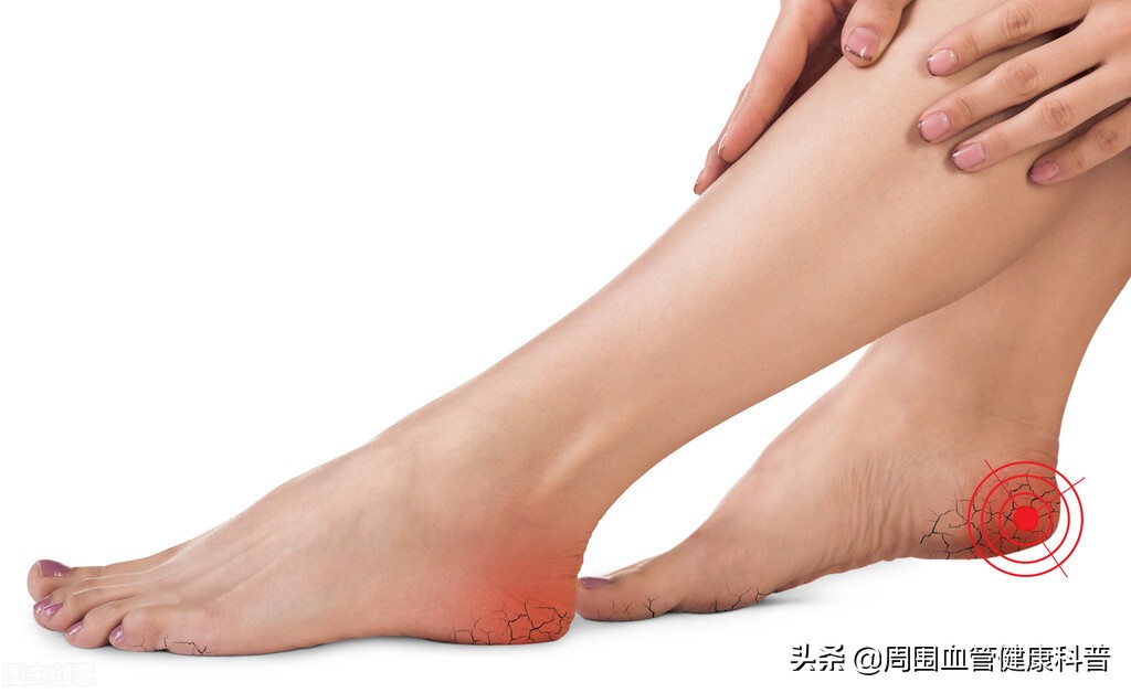 下肢深静脉血栓慢性期要注意什么,下肢深静脉血栓后遗症多久能恢复