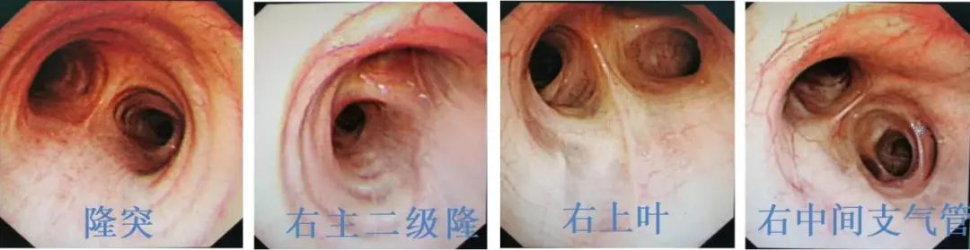 反复发烧但是拍片显示轻微肺炎,一直高烧39-40是肺炎么