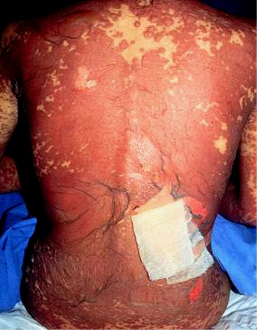 科普：了解一下药疹