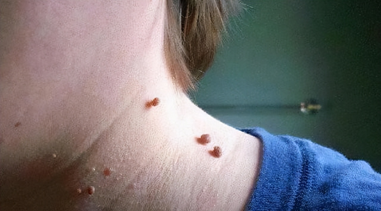 皮肤长“小肉球”是咋回事，可以用手抠掉吗？如何处理？一文看懂