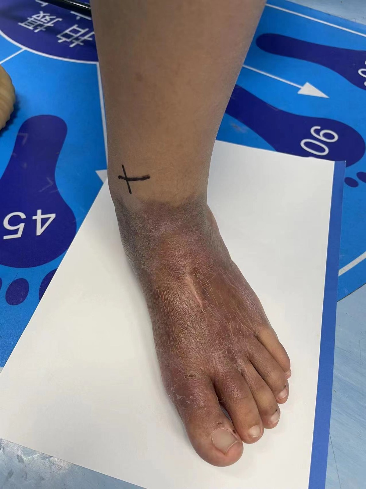 脚底板血管瘤介入治疗,脚底弥漫海绵状血管瘤