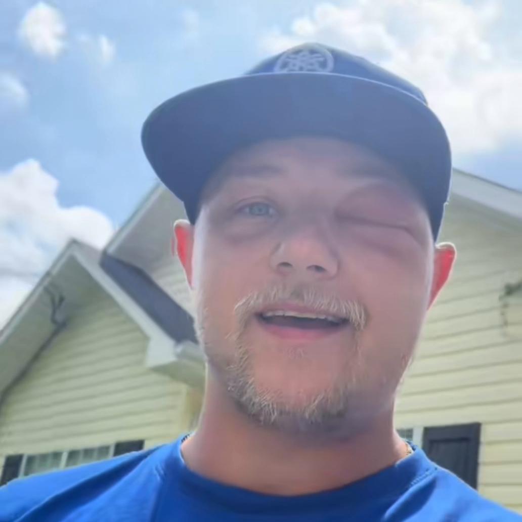 黄蜂蛰了嘴唇为啥越变越大,被黄蜂蛰到嘴唇怎么办