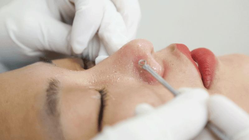 眉心鼻翼和下巴长粉刺为什么,鼻头上起粉刺什么原因引起的图片