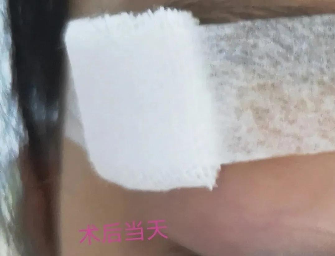 孩子头部皮脂腺囊肿能保守治疗吗,孩子面部皮脂腺囊肿