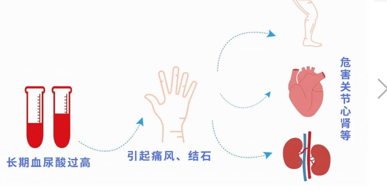 尿酸偏高在睡觉时会发生什么,尿酸高晚上睡觉有四种表现