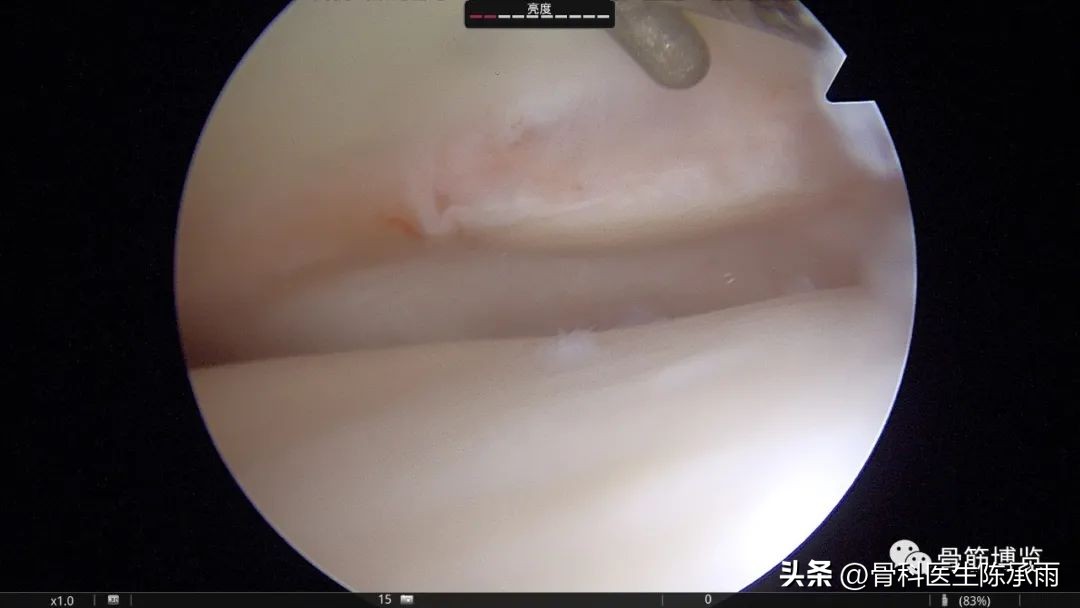 1-2度半月板后角损伤,半月板后角损伤手术解决方案