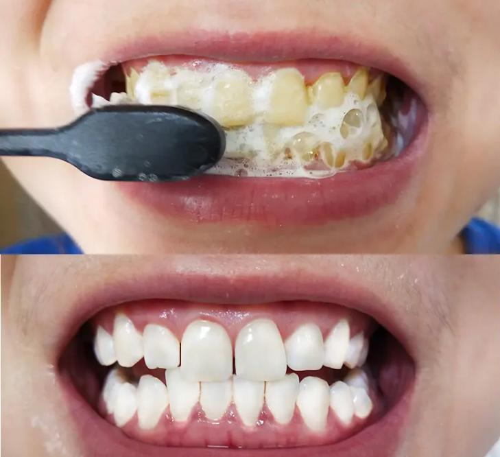 牙齿黑用什么刷牙可以让牙齿变白,用什么刷牙可以去除牙渍还不伤牙