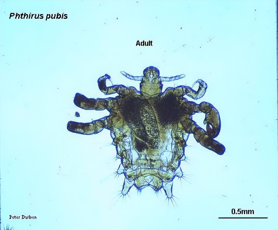 孩子眼睛长阴虱怎么处理,阴虱长在小孩眼睫毛上
