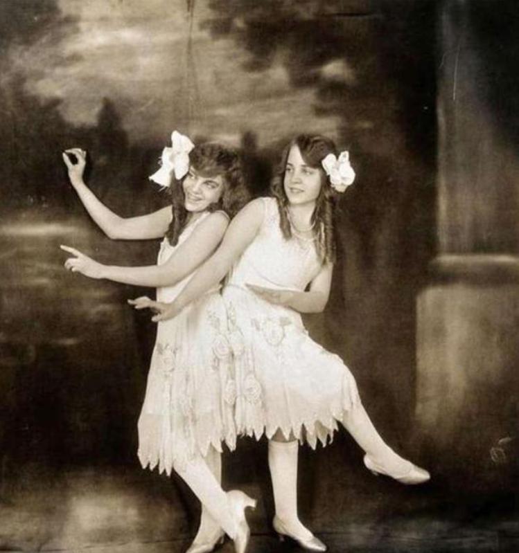 英国连体双胞胎姐妹,英国连体姐妹