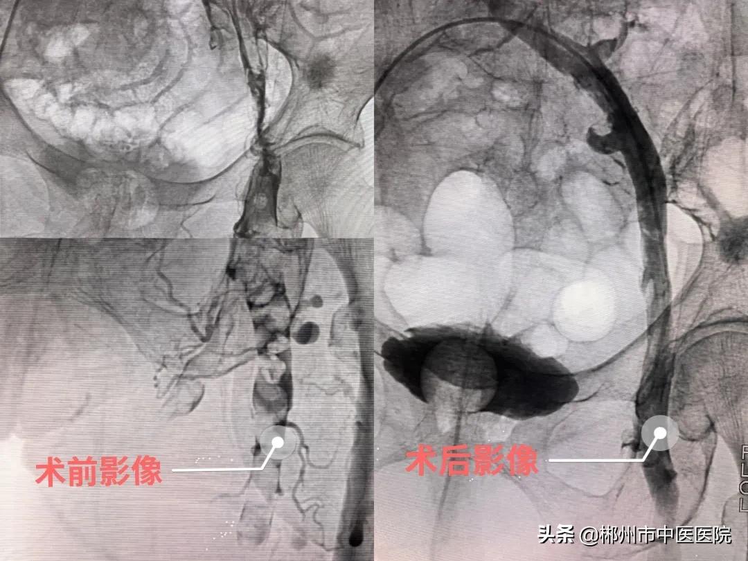 血栓外痔破了该怎么办,面对心血管病最好的办法