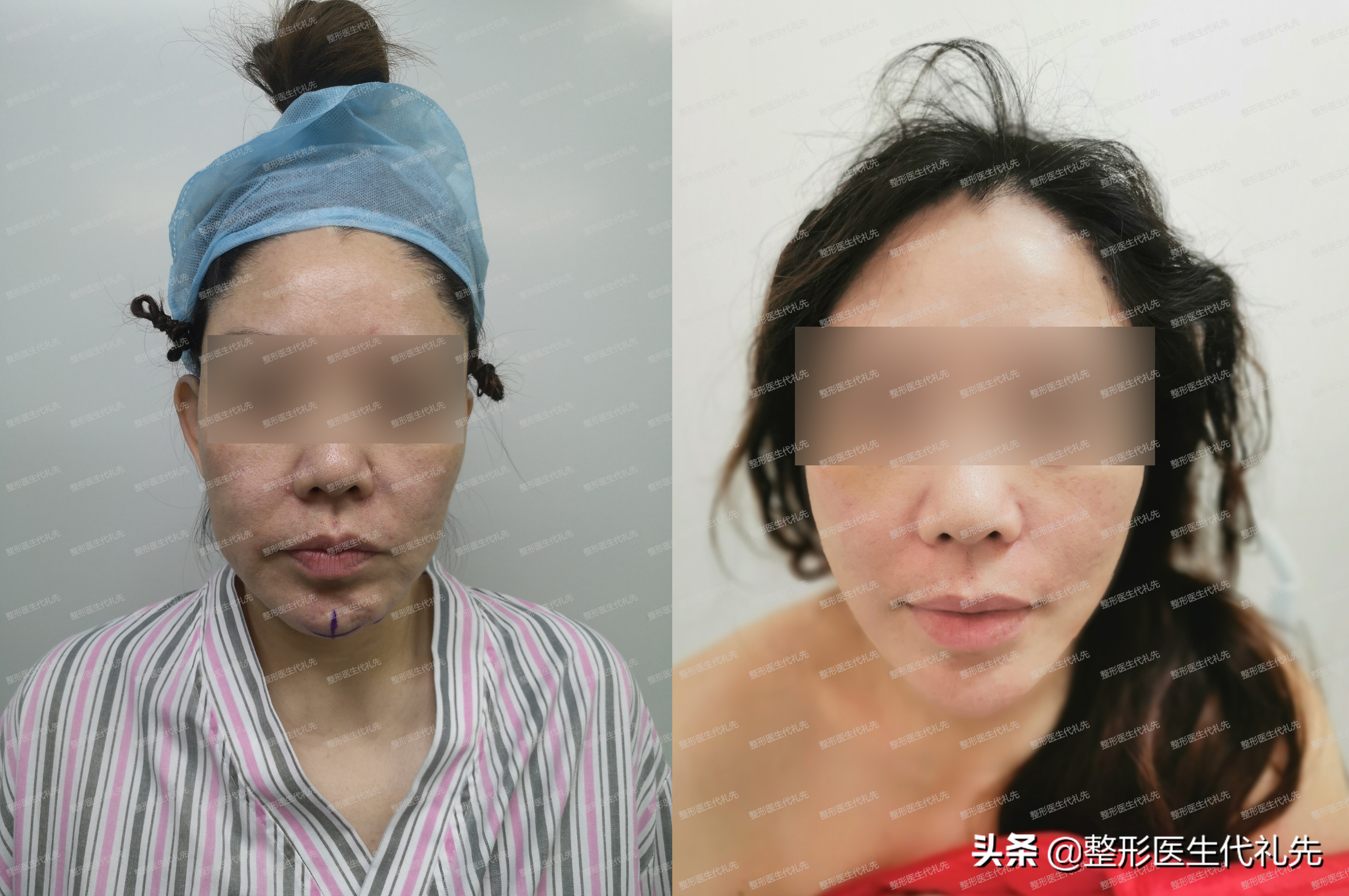 有法令纹最好的解决办法真实有效,法令纹严重最有效的办法