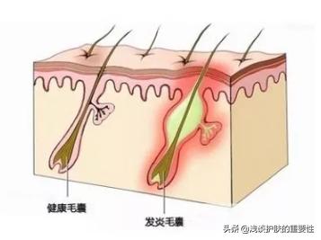 收缩毛孔粗大的方法真的有效,毛孔大怎么改善真的可以收缩毛孔