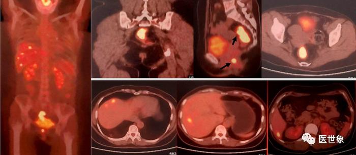 肝癌一针2000元的是什么药,癌症治疗一针120万能治肝癌吗
