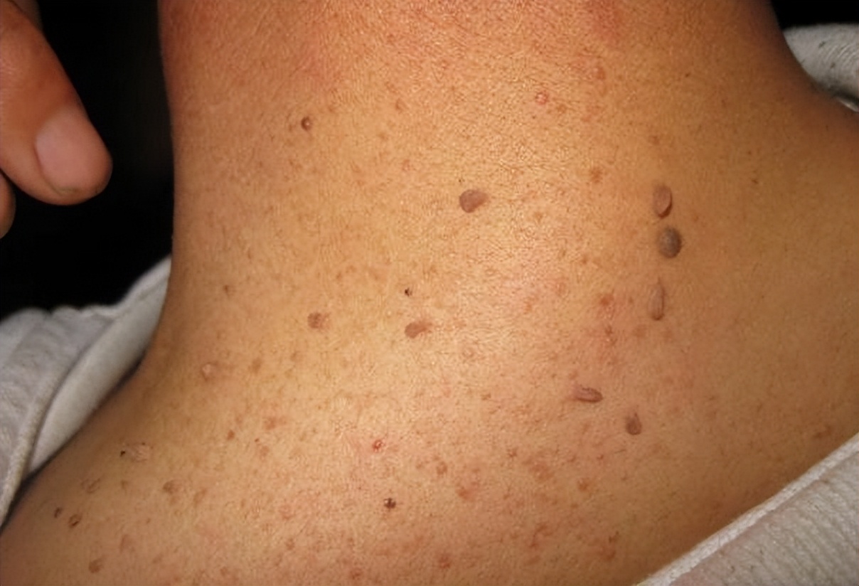 脖子和腋下的“小肉粒”是什么？能直接用手揪掉吗？医生揭露真相