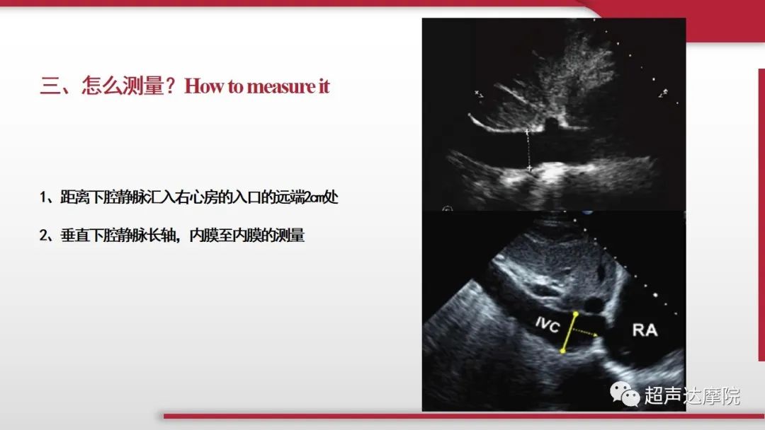 超声下腔静脉评估血容量,超声评估下腔静脉容量图片