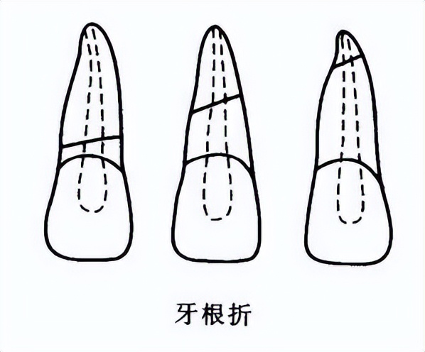 牙齿断了一半怎么处理最好多少钱,牙齿断了一半怕冰怎么处理最好