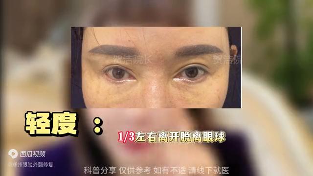 手术后下眼睑外翻怎么自然恢复,外切眼袋后下眼睑外翻多少算正常