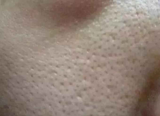 玉泽修复面霜能改善毛孔粗大,鼻子毛孔粗大有黑头怎么修复改善